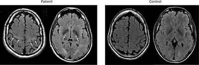 Imaging Biomarkers for the Diagnosis and Prognosis of Neurodegenerative Diseases. The Example of Amyotrophic Lateral Sclerosis